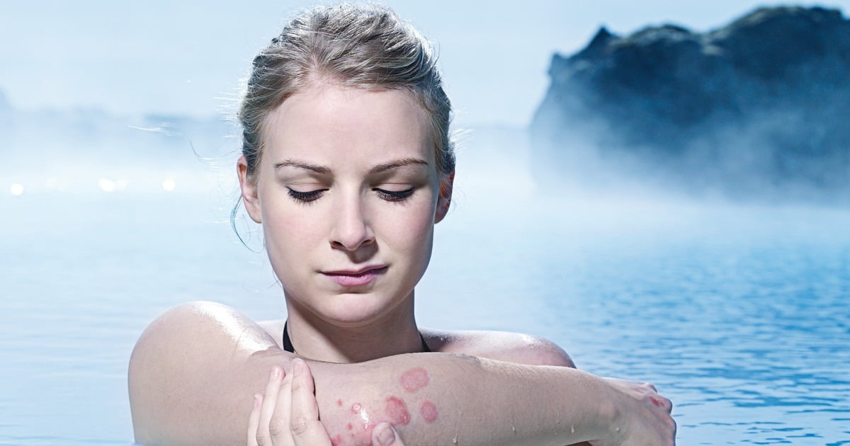 Psoriasis dead sea