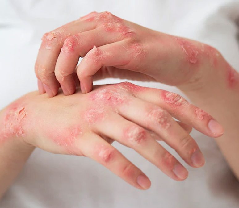 The Psoriasis